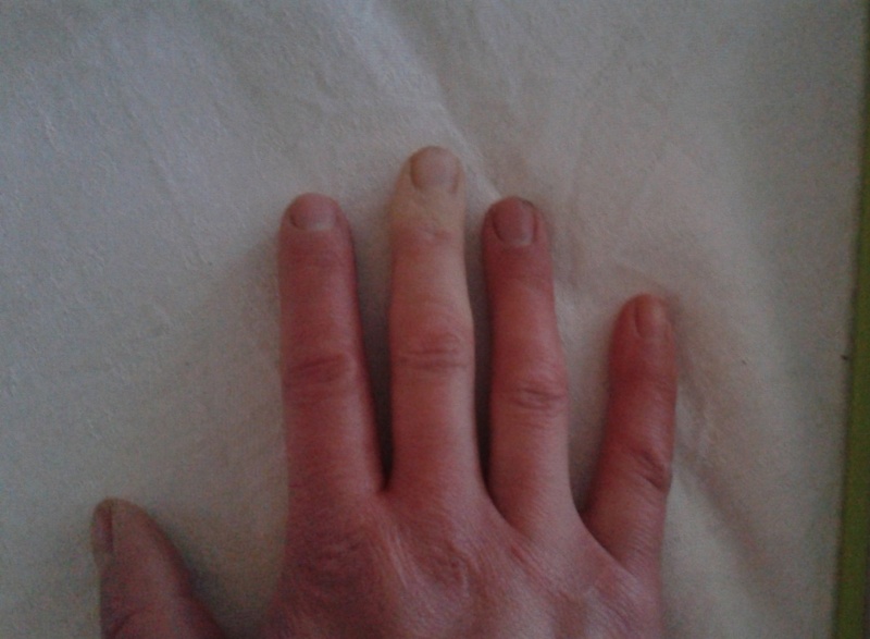 Lätt röd hand där långfintertoppen är vit. 27 mars vitfinger