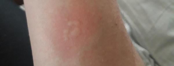 Utslag på Marcus arm