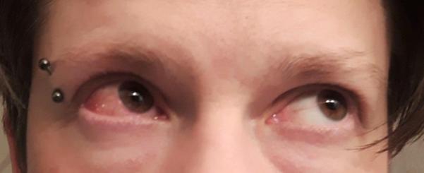 Rött öga på Marcus